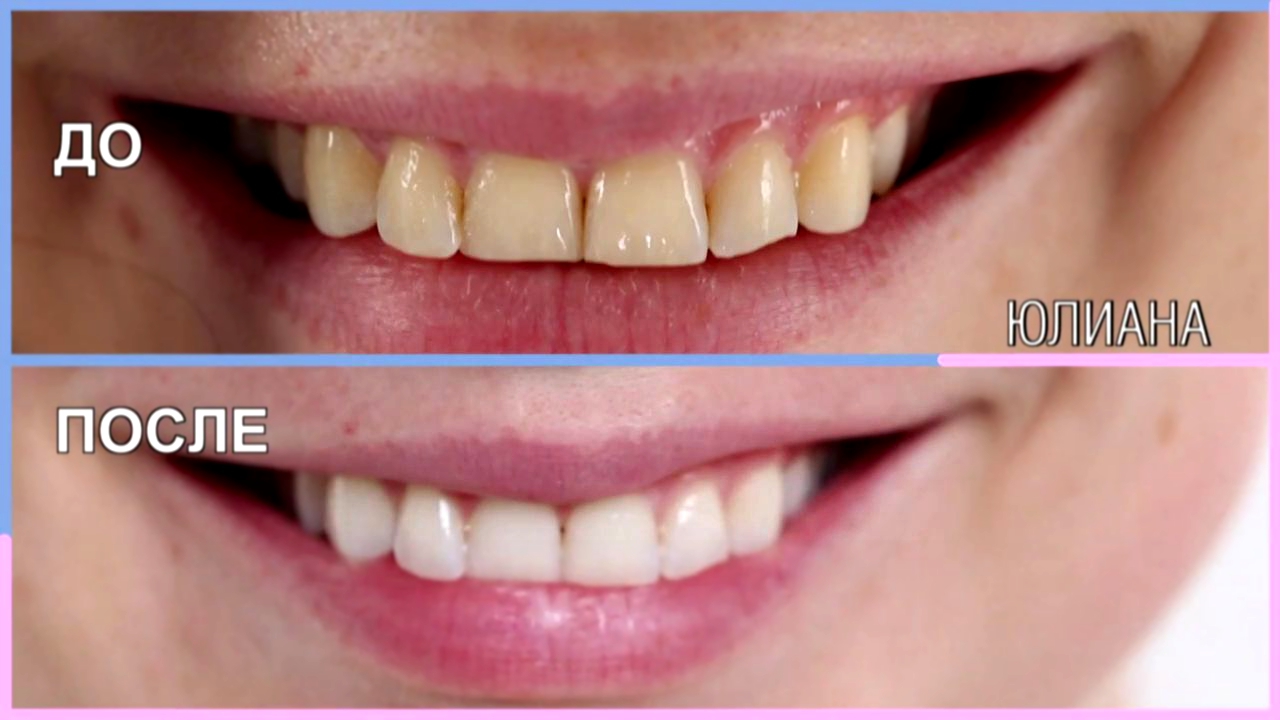 Перезагрузка: Панорамные снимки зубов и чистка зубов у стоматолога